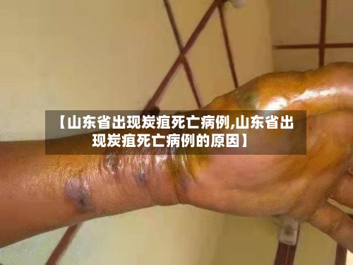 【山东省出现炭疽死亡病例,山东省出现炭疽死亡病例的原因】